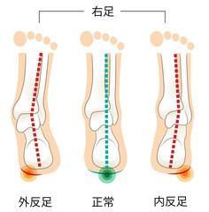 後ろから見た右足の踵骨とかかとの傾き