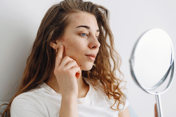 Young woman  with problem skin looking into mirror. Dermatology. Allergic reaction from cosmetic, red spot or rash on face.  Beauty care.  - obrazy, fototapety, plakaty