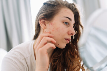 Young woman  with problem skin looking into mirror. Dermatology. Allergic reaction from cosmetic,...