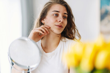 Young woman  with problem skin looking into mirror. Dermatology. Allergic reaction from cosmetic,...