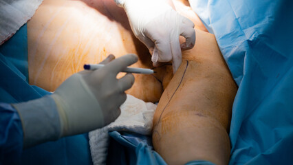 arm lift surgery. Doctor draws with pencil to perform liposuction on woman's arm in arm lift surgery