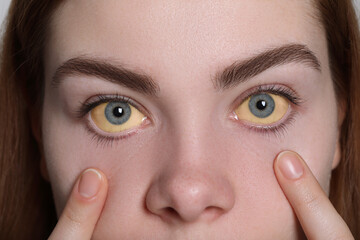 Woman with yellow eyes on white background, closeup. Symptom of hepatitis