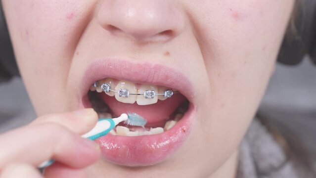 Teenager brushing metal brackets by orthodontic toothbrushes, dental floss. Dental care hygiene concept with braces. Cleaning braces teeth system, close-up. Oral care concept with braces