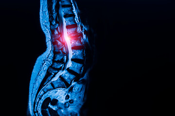 Blue tone radiograph on black background in hospital.Doctor used xray for diagnosis of the back bone pain of patient.MRI technology in spine or spinal stenosis with red light.Medical and orthopedic. - obrazy, fototapety, plakaty
