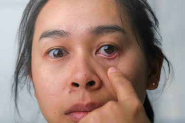 Young woman suffering from eye pain, Allergic to dust, dry eyes, watery eyes, itching. Asian woman...