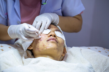 The problem of acne on the face Skin inflammation. The concept of beauty in women. Skin disorders...