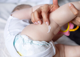 mother hand using cream from jar to apply on baby new born infant legs.child with eczema or dermatitis red spots on foot. rash or kid allergy on body.woman hand massaging putting cream on dry skin