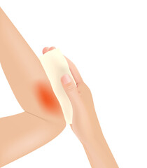 Skin burn injury treatment. First aid for burn wound vector illustration, elbow with skin injury. vector illustration. EPS10.