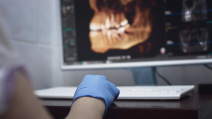 Dentist doctor examines a panoramic x-ray of the jaw on a computer screen. The doctor shows a 3D model of the patient's mouth, MRI scan
