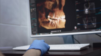 Dentist doctor examines a panoramic x-ray of the jaw on a computer screen. Diagnostic equipment for teeth in a modern dental clinic.
