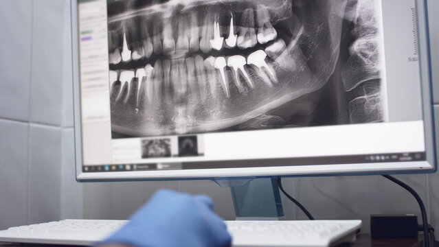 Dentist doctor examines a panoramic x-ray of the jaw on a computer screen. The doctor shows a 3D model of the patient's mouth, MRI scan