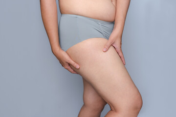 Close-up shot of a woman wearing underwear standing touching thighs, obesity treatment, cellulite...
