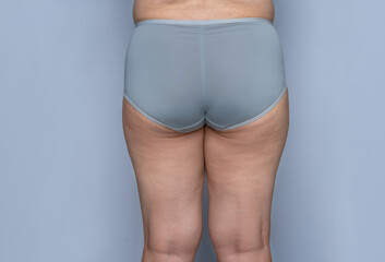 Female body with cellulite, excess weight, loss of collagen, and sagging skin problems. fat hips...