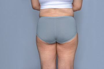 Female body with cellulite, excess weight, loss of collagen, and sagging skin problems. fat hips...
