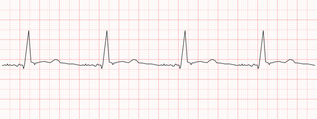 Black heart beat diagram on red graph paper. Electrocardiogram chart example. Cardiac rhythm line. Cardio test sign. Cardiology hospital symbol