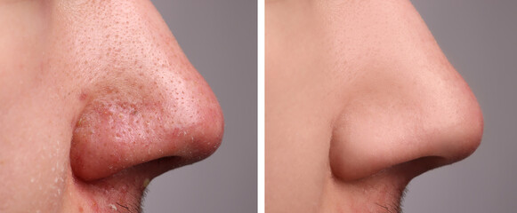 Before and after acne treatment. Photos of man on grey background, closeup. Collage showing...