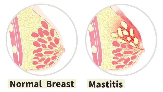 Normal breast and mastitis diagram; English language PNG