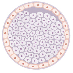 Ductal Carcinoma In Situ (DCIS) Breast cancer diagram PNG