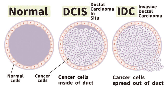 Ductal Carcinoma Of The Breast; English Language PNG