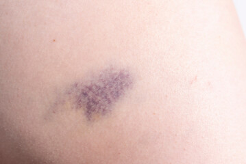 Closeup Blue Purple Hematoma, Bruise On Thigh, Hip After Trauma, Fall. Horizontal plane. Clotted Blood, Injury On Human Body Concept.