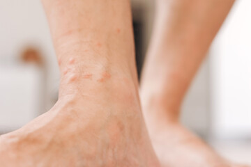 Close up allergic rash dermatitis eczema on man foot. Leg with red rash caused by insect bites. Dermatitis, folliculitis, fungal infection. Affected area of skin to turn red and blotchy and to swell