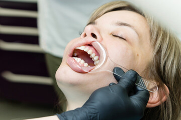 Checkup at dentist. Retractor in patient's mouth