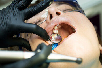 Caries treatment to chewing side tooth upper jaw © Vagengeim