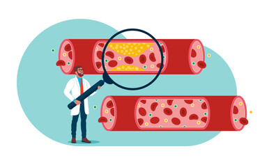 Doctor studying blood vessels and veins from cholesterol and blood cells clot. Cardiovascular system, cardiology, medical examination topics. Heart disease research. Flat vector illustration - obrazy, fototapety, plakaty