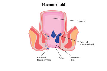 Cross section of the rectum and anal canal. illustration of hemorrhoids structure. vector eps 10 - obrazy, fototapety, plakaty
