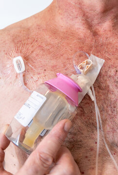 Cancer Chemotherapy Patient Examining Iv Chest Port Stock Photo