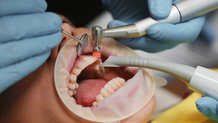 Using tool to clean the teeth. Installation of aligner. Woman in the stomatology clinic, visiting dentist.