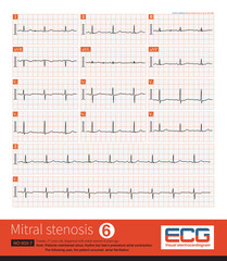 Female, 57 years old, diagnosed with mitral stenosis 6 years ago. When this ECG was taken, the patient still maintained sinus rhythm and developed atrial fibrillation the following year.