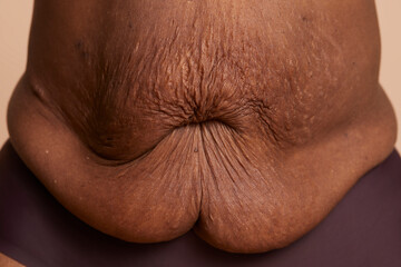Close-up of senior woman belly with stretch marks