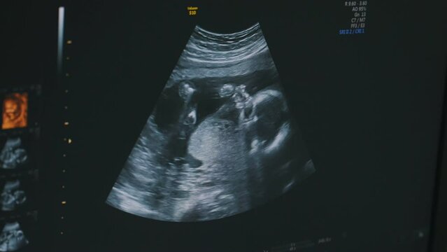 Black and white colors. Pregnant baby infant ultrasound display. Conception of health care.