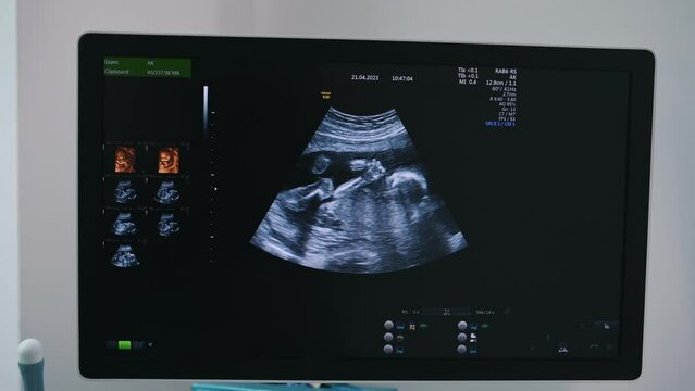 Pregnant baby infant ultrasound display. Conception of health care.