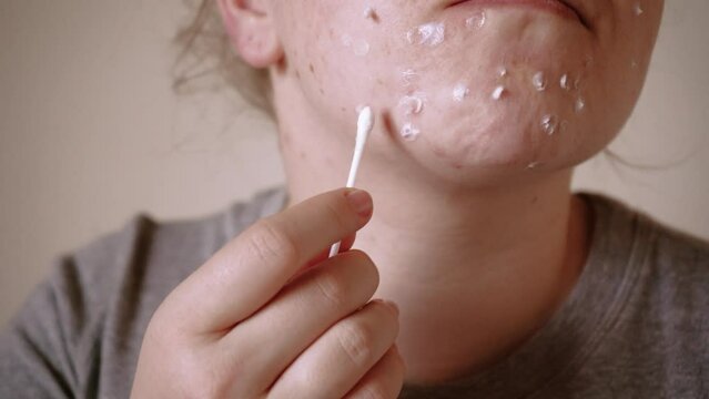 Close up of skin problems, unhealthy skin with acne and pimples. Porous, demodex and rosacea, red rashes. The concept of care for problem skin. Allergic and redness.