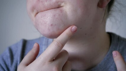 Close up of skin problems, unhealthy skin with acne and pimples. Porous, demodex and rosacea, red rashes. The concept of care for problem skin. Allergic and redness.