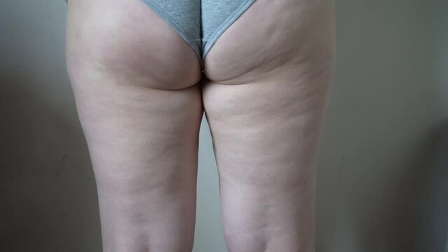 Thigh of a woman with cellulite. Figure problem, cosmetic massage. An overweight girl massages her leg with her hands and checks for cellulite.