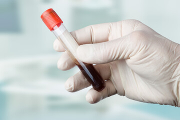 close-up of hands in medical gloves handling a blood test tube for analysis