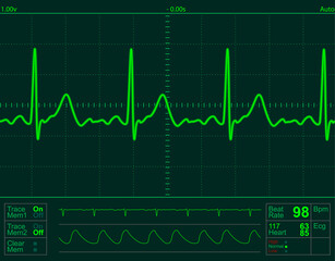 heart monitor screen with normal beat signal