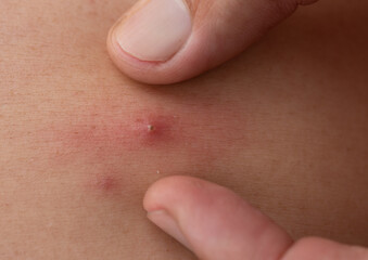 Black dots on face and pimples,close up of acne