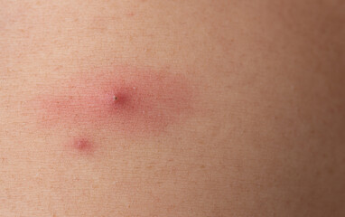 Black dots on face and pimples,close up of acne