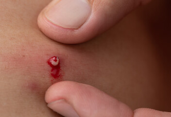Two fingers squeeze pustule acne drain out with blood
