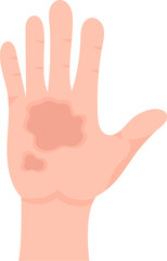 1st Degree Of Skin Burn