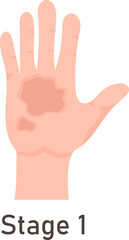 1st Degree Of Skin Burn