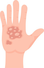 2nd Degree Of Skin Burn