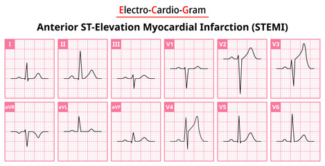 Naklejka premium Anterior STEMI (ST-Elevation Myocardial Infarction) - The Differences in ECG Waveform for Each of the 12 Leads - Vectors and Illustrations for Medical Purposes