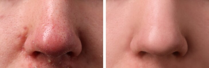 Fototapeta premium Photos of man before and after acne treatment, closeup. Collage showing affected and healthy skin