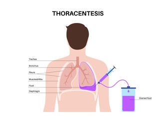 Thoracentesis medical procedure