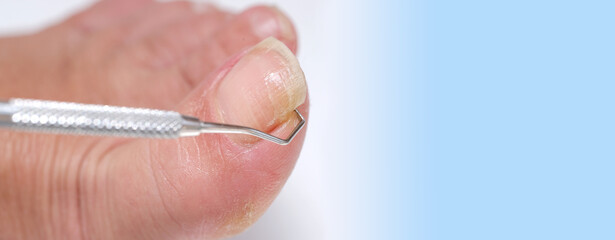 dermatologist, dermatovenereologist, podologist treats damaged rude nail on big toe of female foot,...